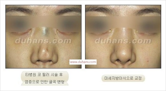 [두한성형외과 경쟁력 눈밑성형] - [Dr. 컬럼 필러 시술의 부작용에 대한 우려] 관련 이미지 2