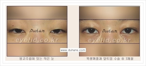 [두한성형외과 경쟁력 쌍꺼풀 재수술, 극한 재수술] - [퀵쌍꺼풀(부분절개법) 안내] 관련 이미지 5