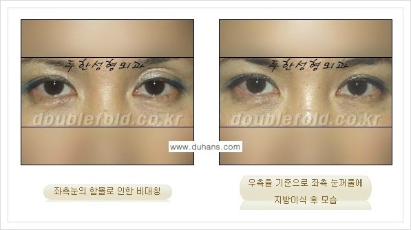 [두한성형외과 경쟁력 쌍꺼풀 재수술] - [짝짝이(비대칭) 쌍꺼풀 라인 교정하는 방법 안내 2.] 관련 이미지 10