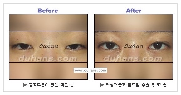 [두한성형외과 경쟁력 쌍꺼풀 재수술, 극한 재수술] - [퀵쌍꺼풀 안내] 관련 이미지 2