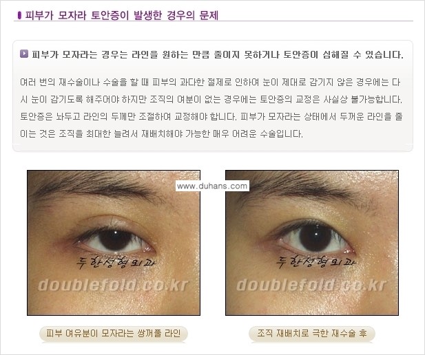 [두한성형외과 경쟁력 있는 쌍꺼풀 재수술] - [극복해야 할 극한의 상황과 문제들] 관련 이미지 8
