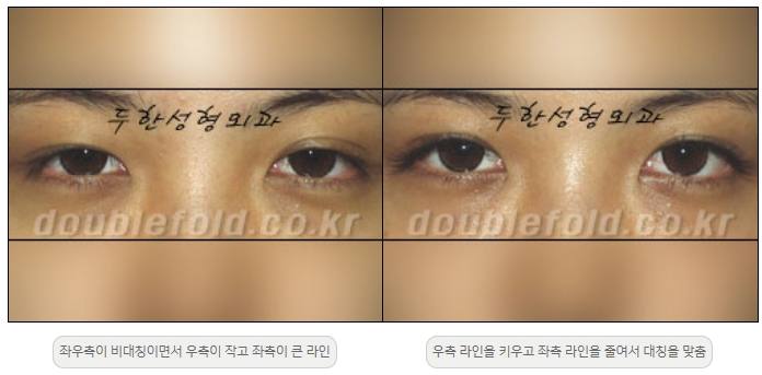 [두한성형외과 쌍커플재수술] - [비대칭 쌍커풀 라인] 관련 이미지 14
