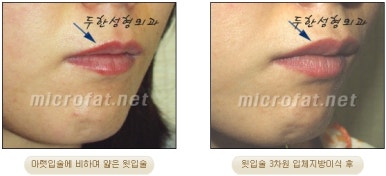 [두한성형외과 입술성형] - [볼륨감 있는 입술 미세지방이식] 관련 이미지 19