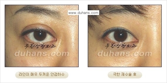[두한성형외과 경쟁력 눈성형] - [두꺼운 라인을 교정하는 극한 눈 재수술 1.] 관련 이미지 16