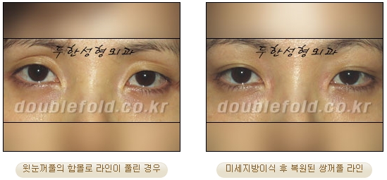 [두한성형외과 쌍커풀수술] - [눈성형 방법에 대한 자주하는 질문과 답변] 관련 이미지 107