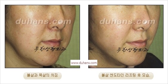 [두한성형외과 경쟁력 주름성형] - [간단하고 부작용 없는 자연스러운 주름제거 방법] 관련 이미지 29