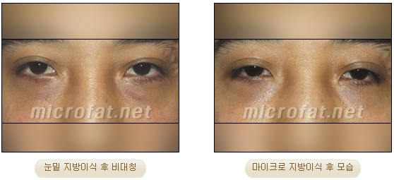 [두한성형외과 지방이식] - [타병원의 지방이식 부작용 교정] 관련 이미지 33