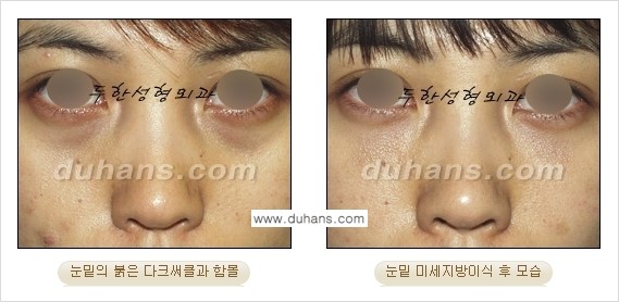 [두한성형외과 경쟁력 미세지방이식] - [다크써클 & 눈밑주름 미세지방이식 3.] 관련 이미지 6