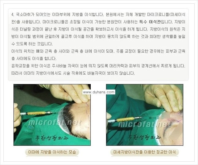 [두한성형외과 경쟁력 미세지방이식] - [부드럽고 아름다운 얼굴 윤곽선 이마(전두부) 미세지방이식] 관련 이미지 7