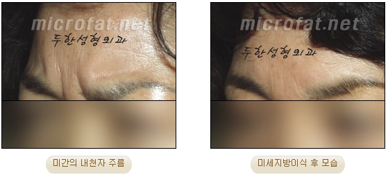 [두한성형외과 자가지방이식] - [미간주름] 관련 이미지 6