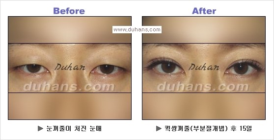 [두한성형외과 경쟁력 눈성형] - [Dr. 컬럼  "어떤 쌍꺼풀이 아름다운 쌍꺼풀인가?!] 관련 이미지 16