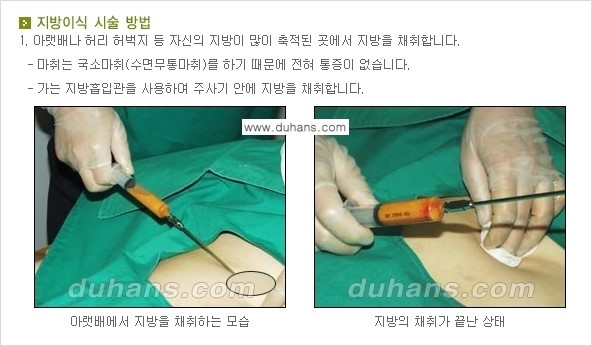 ​​​⁠[두한성형외과 경쟁력 미세지방이식] - [귀족수술 - 입체미세지방이식 ②] 관련 이미지 3