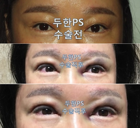 [두한ps]-#쌍꺼풀 재수술로 흉터 개선 &여러겹 쌍꺼풀 라인 개선 관련 이미지 2