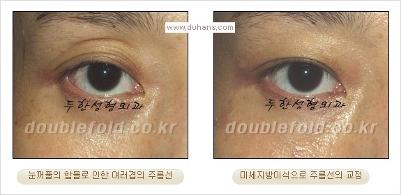 [두한성형외과 경쟁력 쌍꺼풀 재수술] - [삼중(세겹) 쌍꺼풀 라인, 눈꺼풀이 함몰된 삼중(세겹) 쌍꺼풀 라인 교정] 관련 이미지 16