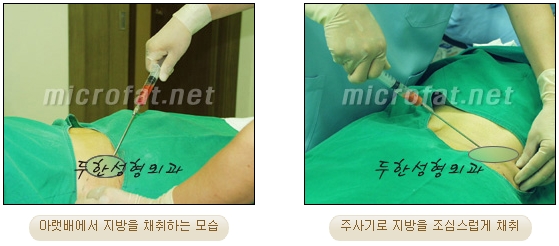 [두한성형외과 지방이식] - [타병원의 지방이식 부작용 교정] 관련 이미지 15