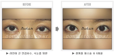 두한성형외과 쌍커풀 재수술 - 짝눈 눈매교정, 가성 안검하수 교정과 뒤밑트임 관련 이미지 50