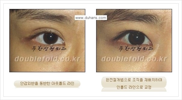 [두한성형외과 경쟁력 쌍꺼풀(눈) 재수술] - [심한 아웃폴드 라인을 인폴드 라인으로의 교정 안내] 관련 이미지 5