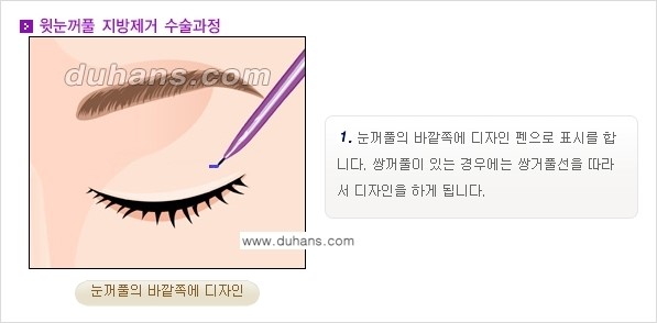 [두한성형외과 경쟁력 지방제거, 지방재배치] - [상큼하고 젊은 눈매 만들기 안내] 관련 이미지 3