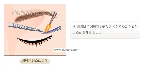 [두한성형외과 경쟁력 지방제거, 지방재배치] - [상큼하고 젊은 눈매 만들기 안내] 관련 이미지 7