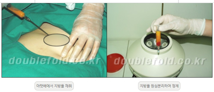 [Duhan Plastic Surgery Double Eyelid Revision] - [Thick Double Eyelid Line] image 16