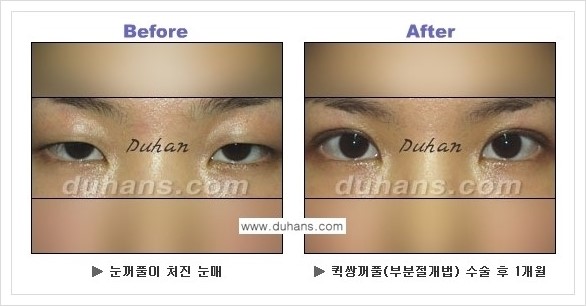 [두한성형외과 경쟁력 쌍꺼풀 재수술, 극한 재수술] - [퀵쌍꺼풀 안내] 관련 이미지 6