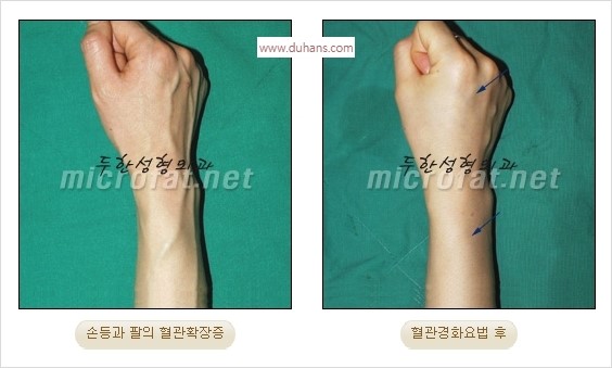 [두한성형외과 경쟁력 정맥류] - [손, 팔의 정맥확장증(혈관확장증) 치료 방법 안내] 관련 이미지 14