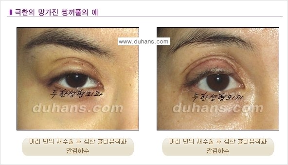 [두한성형외과 경쟁력 눈성형] - [두꺼운 라인을 교정하는 극한 눈 재수술 1.] 관련 이미지 2
