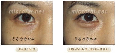 두한성형외과 눈밑성형 - 애교필러 후 눈밑재수술 관련 이미지 55