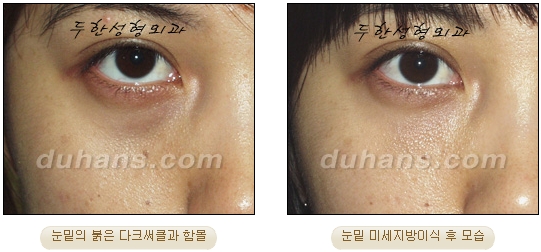 [두한성형외과 지방이식] - [눈밑 다크써클] 관련 이미지 27