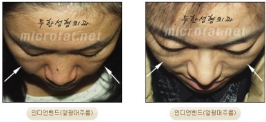 [Duhan Plastic Surgery Face Autologous Fat Grafting] - [Noble Surgery and Indian Band Fat Grafting] image 7