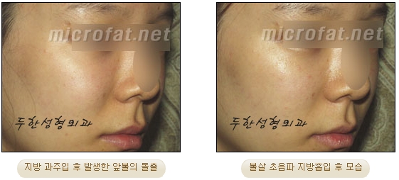 [Duhan Plastic Surgery Liposuction] - [Facial Liposuction] image 29