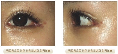 [Duhan Plastic Surgery Eyelid Surgery] - [Epicanthoplasty, Medial Canthoplasty] image 19
