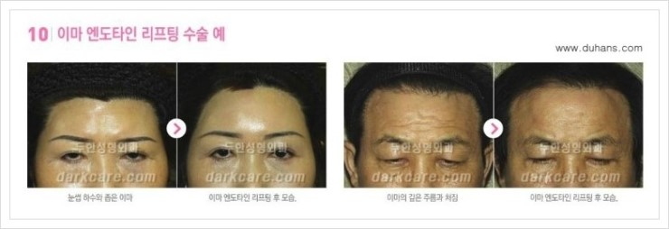 [두한성형외과 경쟁력 주름성형] - [피부 처짐, 표정주름에 효과적인 내시경 엔도타인 리프팅] 관련 이미지 19