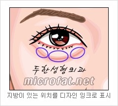 두한성형외과 눈밑성형 - 눈밑지방제거, 눈밑주름, 눈밑지방재배치 관련 이미지 3