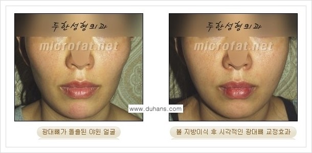 [두한성형외과 경쟁력 안면윤곽 성형] - [광대뼈 돌출, 사각턱, 야윈볼살, 역삼각형의 협소한 얼굴, 측면 볼살의 함몰선, 안면비대칭 미세지방이식] 관련 이미지 4