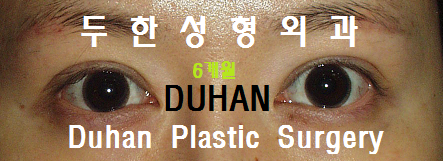 두한성형외과  #쌍꺼풀재수술 ( #라인낮추기, #눈매교정) 관련 이미지 6