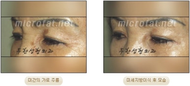 Duhan Plastic Surgery Wrinkle Improvement - Glabellar Horizontal Wrinkles, Glabellar Straight Wrinkles, Glabellar Wrinkle Surgery image 12