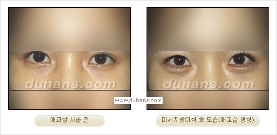 [두한성형외과 경쟁력 눈밑성형] - [눈밑애교살 시술을 위한 미세지방이식] 관련 이미지 16