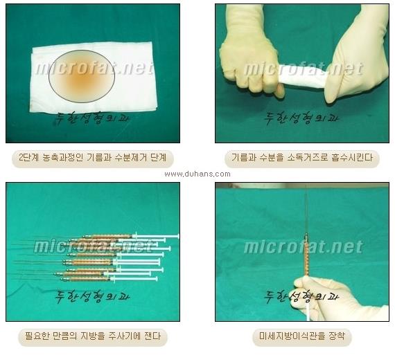 ​[두한성형외과 경쟁력 미세지방이식] - [타 병원에서 지방이식 후 발생한 굴곡현상 교정 방법 - 마이크로 지방이식] 관련 이미지 3