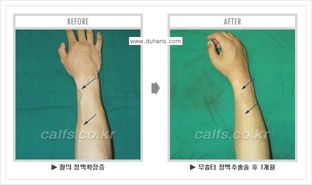 ⁠⁠[두한성형외과 정맥류 치료] - [손, 팔 정맥확장증 사진자료 안내 ②] 관련 이미지 11