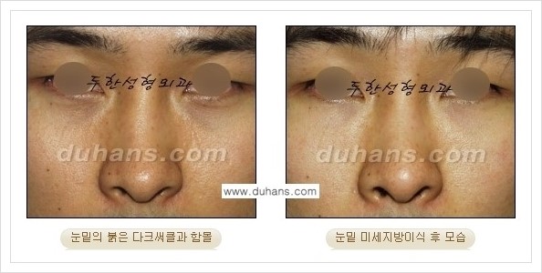 [두한성형외과 경쟁력 눈밑성형] - [꺼진 눈밑, 눈밑 함몰 주름선 눈밑 미세지방이식 안내] 관련 이미지 23