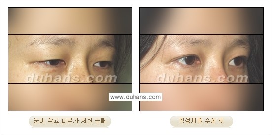 [두한성형외과 경쟁력 눈성형]- [최소 부기로 일상의로의 복귀가 가능한 아름다운 퀵쌍꺼풀(부분절개법) 수술] 관련 이미지 12