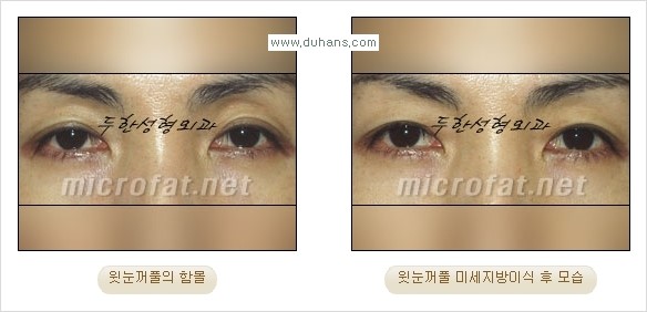 [두한성형외과 경쟁력 미세 #지방이식 ] - [윗 #눈꺼풀함몰, #꺼진눈꺼풀, #눈위지방이식, #눈위함몰] 관련 이미지 21