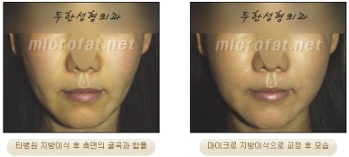[두한성형외과 얼굴지방이식] - [볼지방이식] 관련 이미지 35