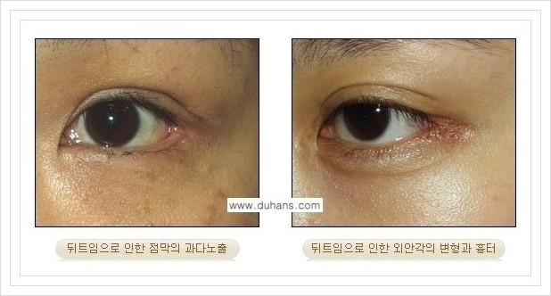 [두한성형외과 경쟁력 쌍꺼풀 재수술, 극한 눈재수술] - [뒤트임 부작용과 뒤트임 교정수술 방법 안내] 관련 이미지 2