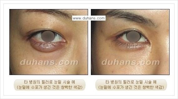 [두한성형외과 경쟁력 주름성형] - [필러주사(쥬비덤)에 대한 올바른 정보 안내] 관련 이미지 11
