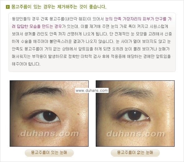 [두한성형외과 경쟁력 눈성형] - [매력적인 쌍꺼풀이란?] 관련 이미지 6