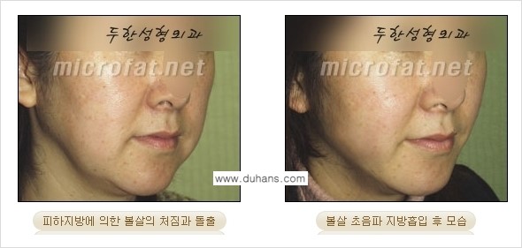 [두한성형외과 경쟁력 지방흡입] - [얼굴, 볼살, 턱살, 턱선의 초음파 지방흡입] 관련 이미지 17