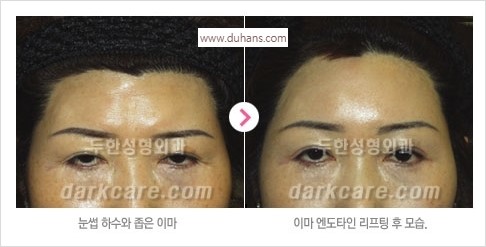[두한성형외과 경쟁력 주름성형] - [주름제거와 볼륨을 갖게하는 엔도타인 리프팅] 관련 이미지 23