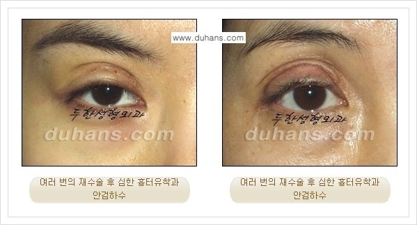 [두한성형외과 경쟁력 극한 재수술, 쌍꺼풀 재수술] - [쌍꺼풀 재수술이 어렵거나 불가능한 경우의 안내] 관련 이미지 1